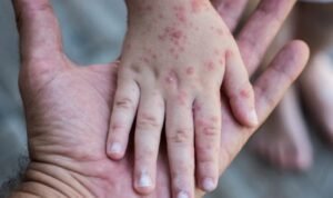 Waspada Lonjakan Campak, Dinkes Kota Malang Genjot Imunisasi Massal Anak